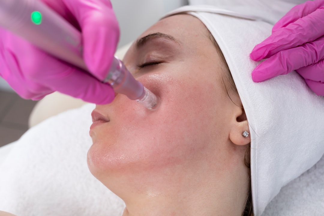 Microagulhamento na Melloclinic