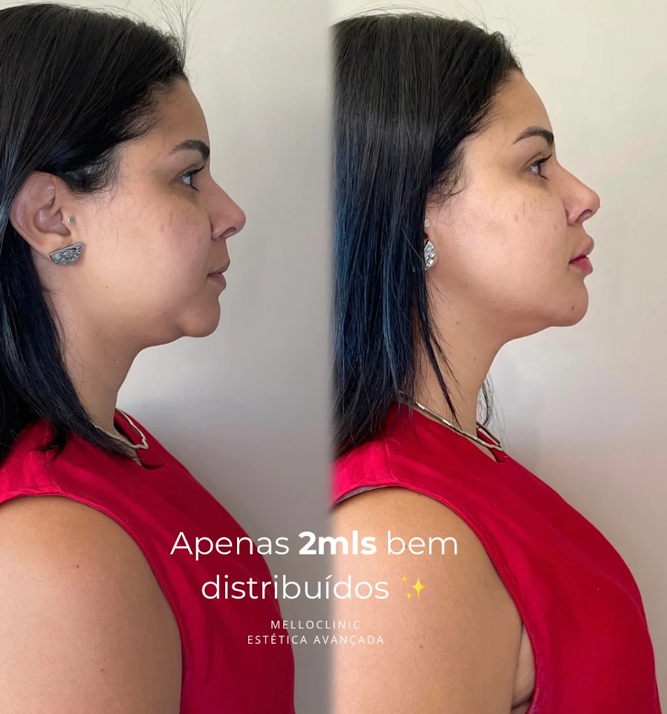 Antes e depois de harmonização facial na Melloclinic