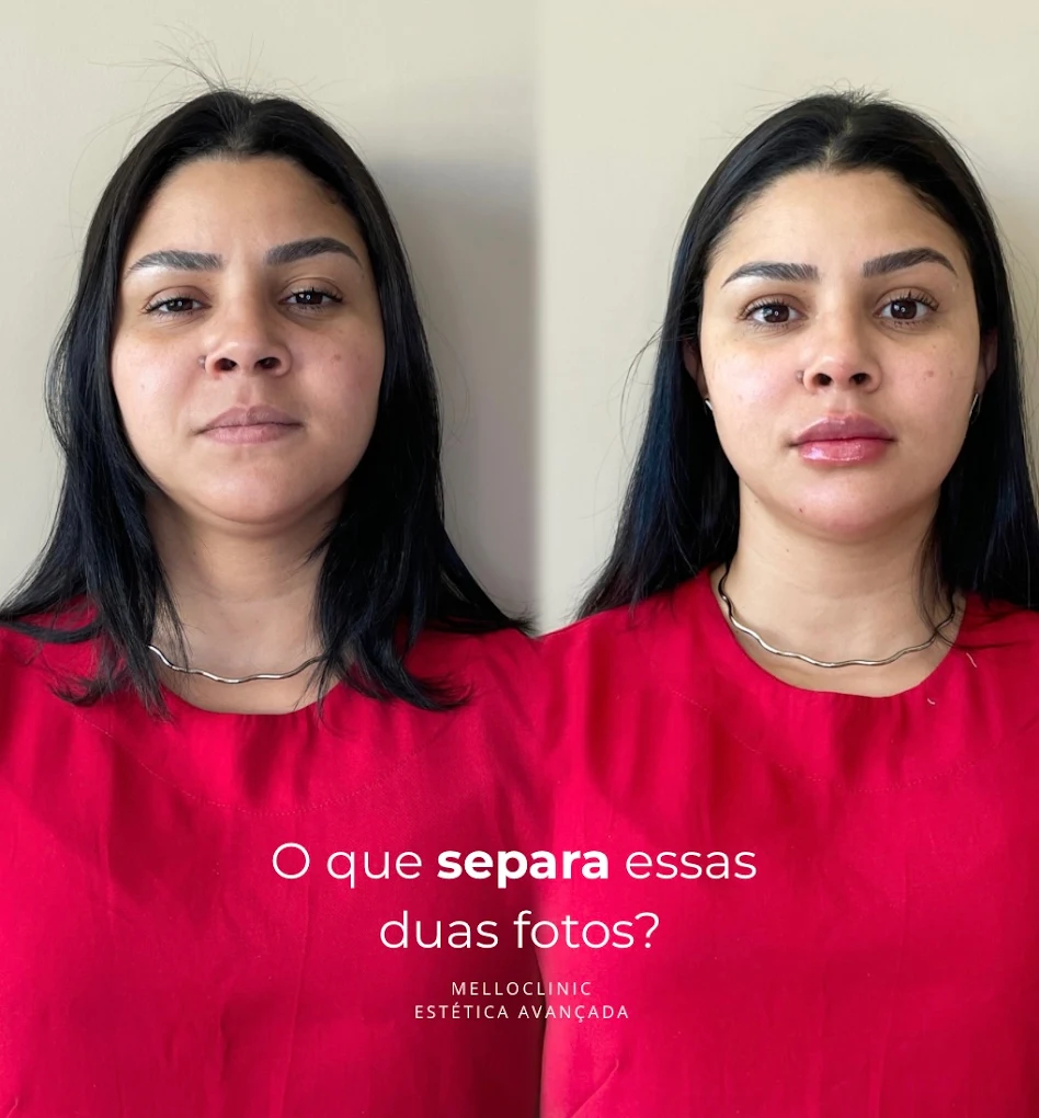 Antes e depois de preenchimento labial na Melloclinic