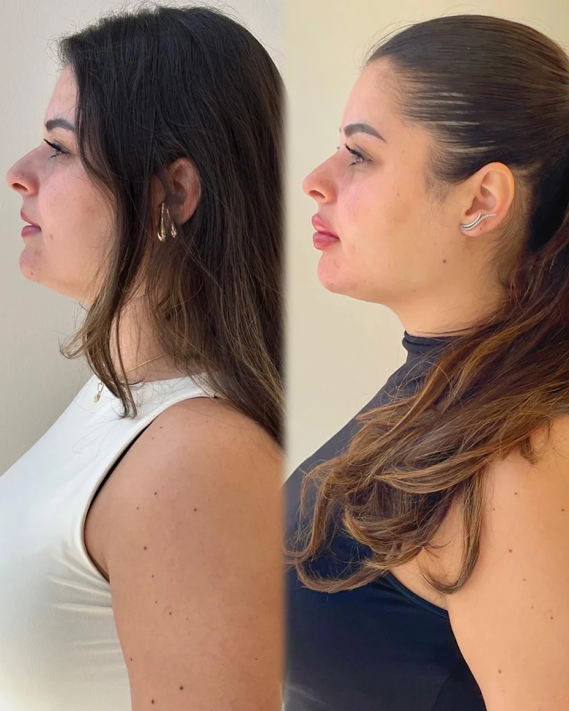 Antes e depois de contorno de perfil na Melloclinic